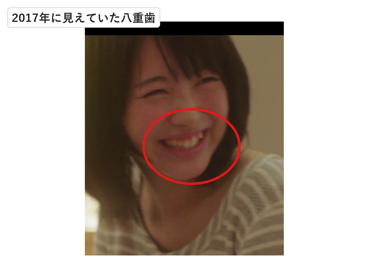 2017年の浜辺美波の笑顔で八重歯を赤丸で示した画像