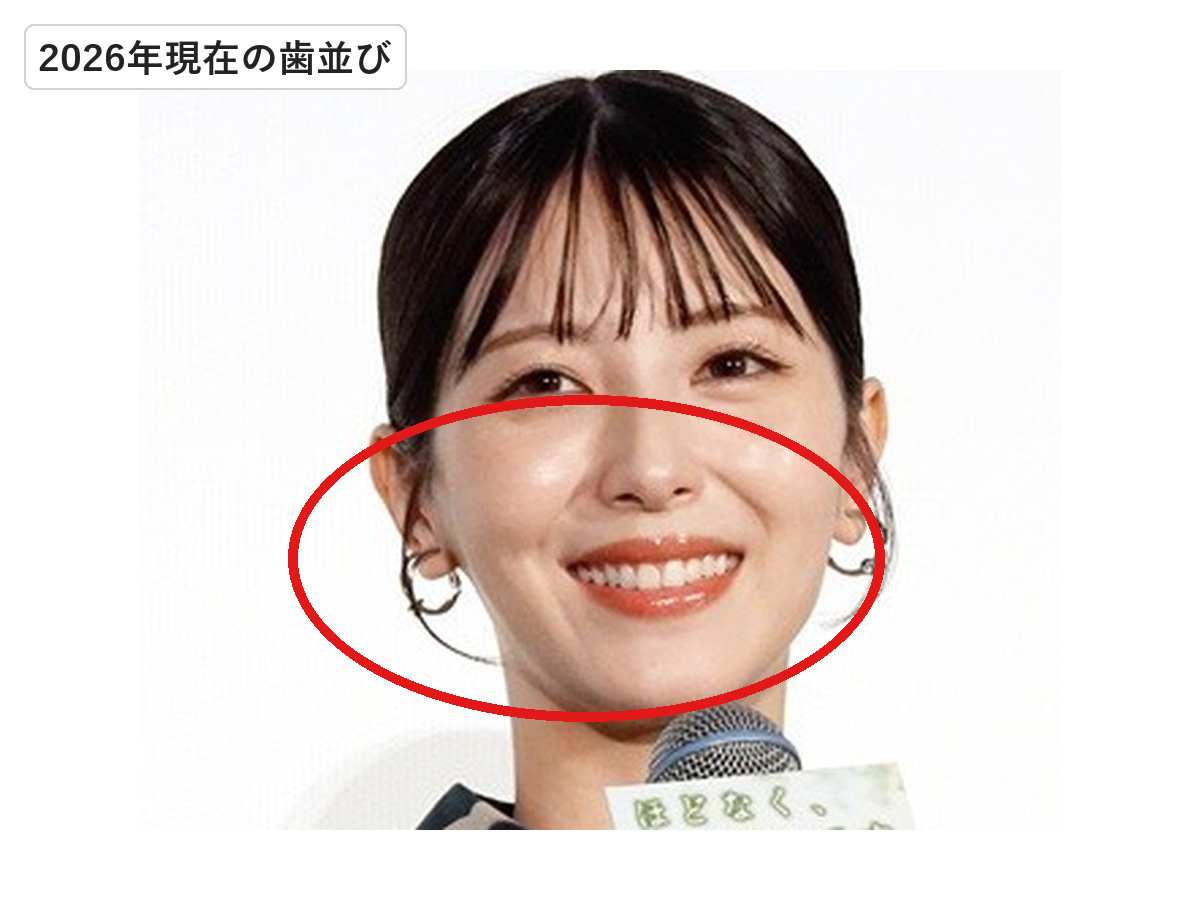 2026年の浜辺美波の笑顔で現在の歯並びを赤丸で示した画像