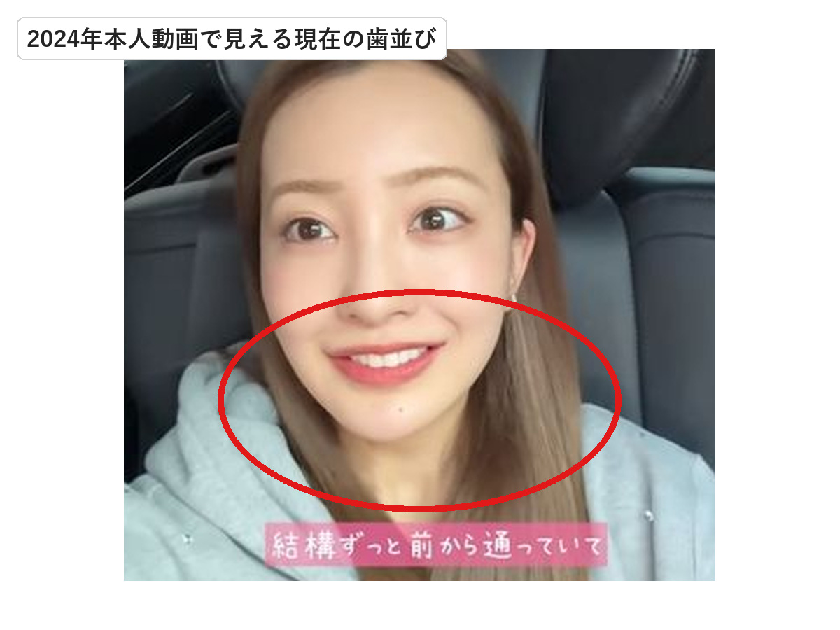 2024年の板野友美の笑顔で現在の歯並びを赤丸で示した画像