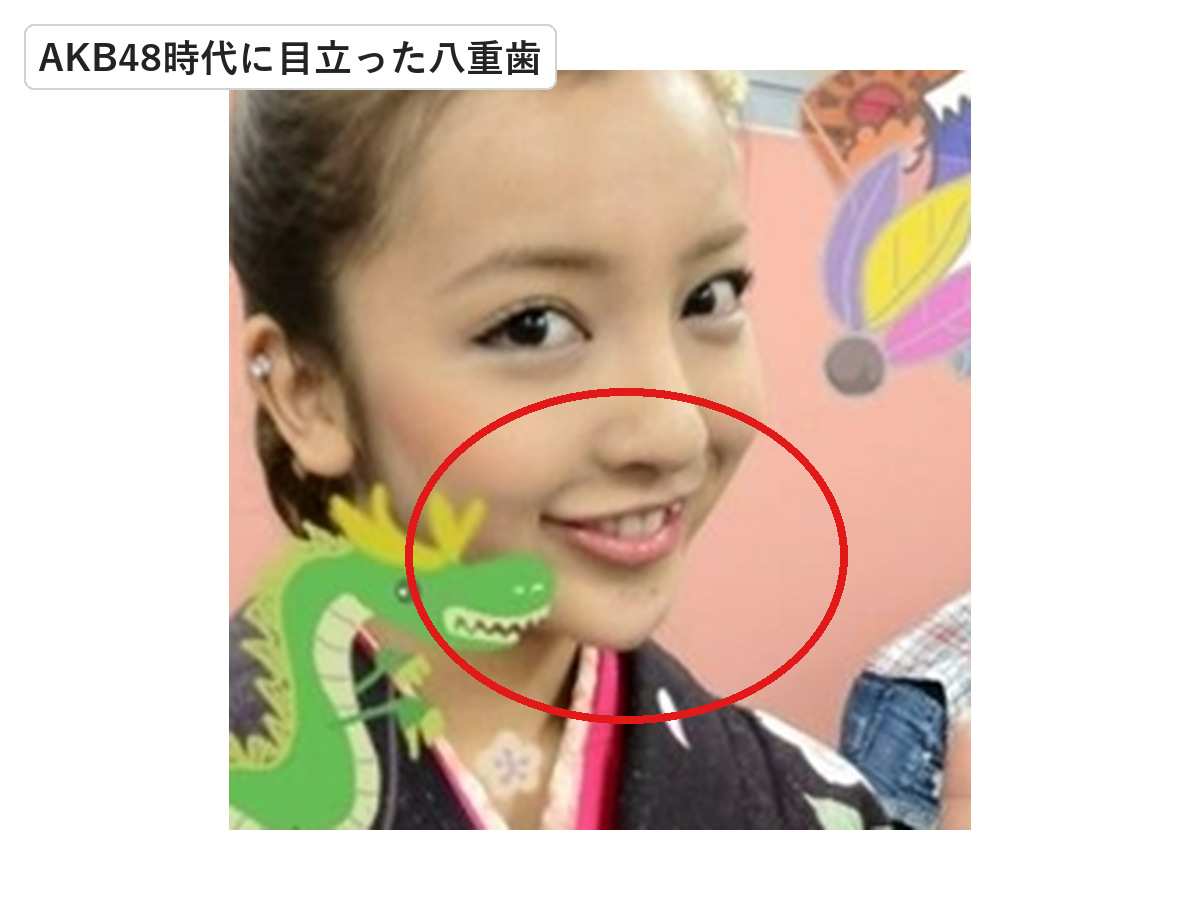 2012年の板野友美の笑顔で八重歯を赤丸で示した画像