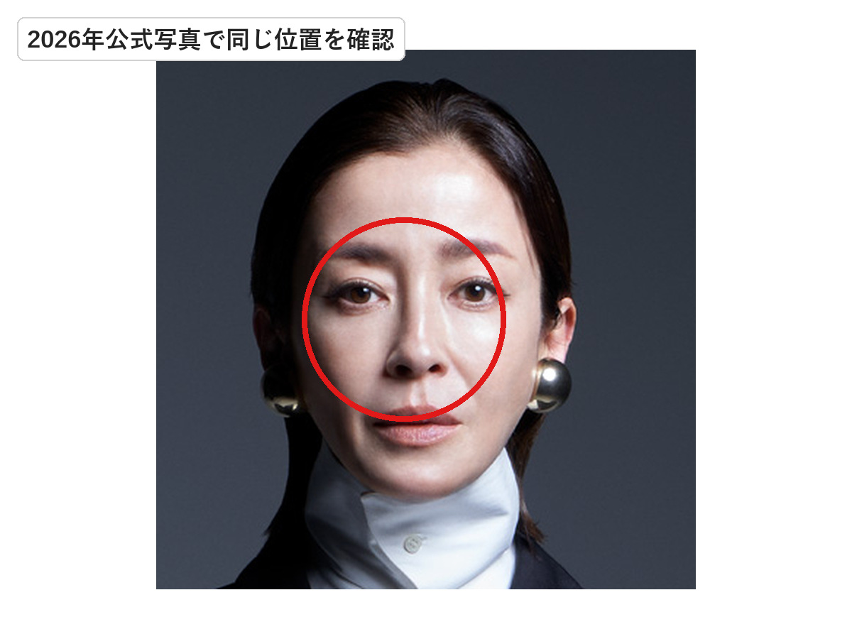 2026年の宮沢りえの鼻横で以前ほくろがあった位置を赤丸で示した画像